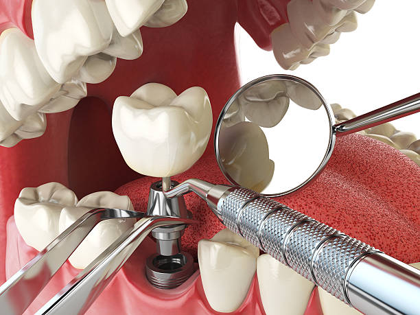 Best Urgent Care for Lost Fillings or Crowns in Charlotte Park, FL